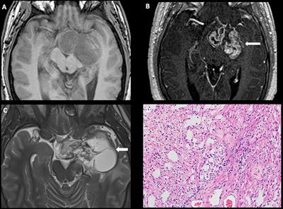 Pediatric diencephalic tumors: a constellation of entities and management modalities